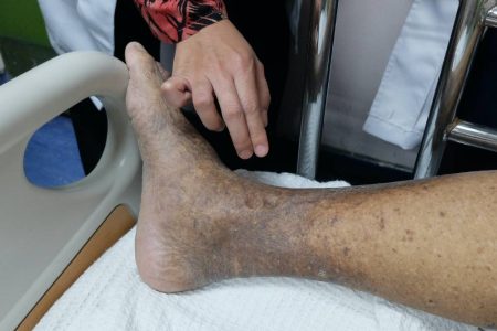 Peripheral Arterial Disease (PAD)